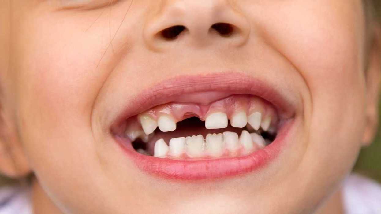 A smiling child's mouth with hole between the teeth
