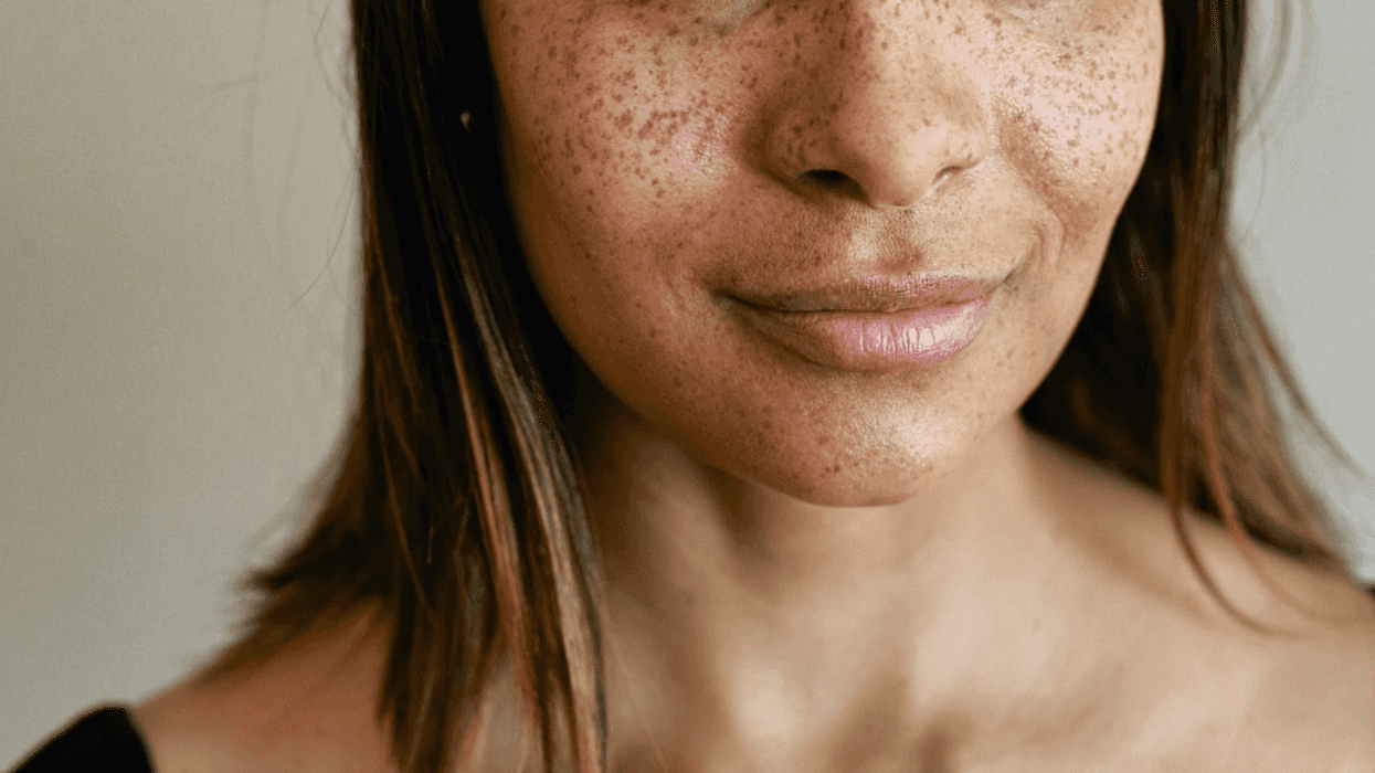 A woman with freckles on her face.