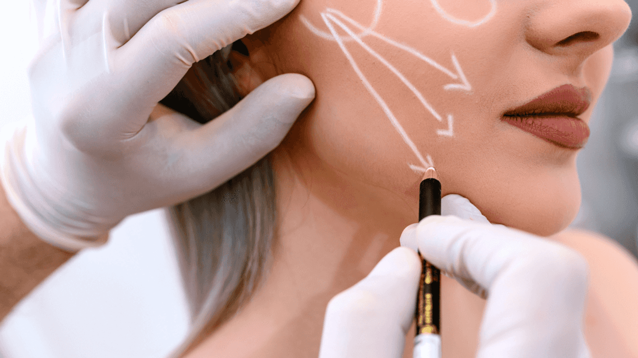 A young woman marked up for plastic surgery