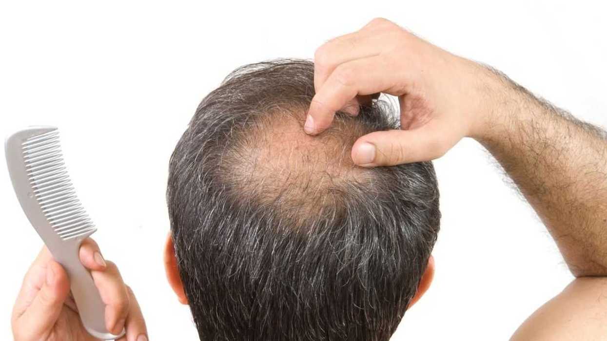 Husband Convinced His Wife Will Leave Him Because He's Balding Even Though She's Literally Bald