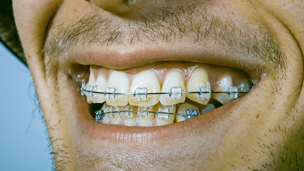 Man smiling with braces