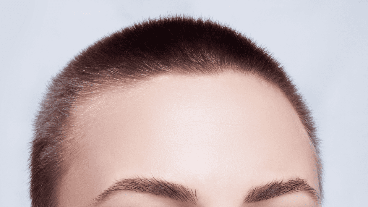 Teen Upsets Sister By Refusing To Shave Her Head In Solidarity After Hair Bleaching Incident