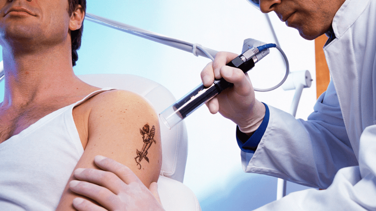 Person getting a tattoo removed