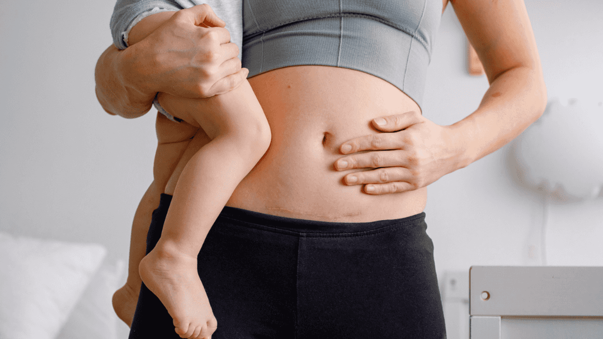 Tummy after pregnancy