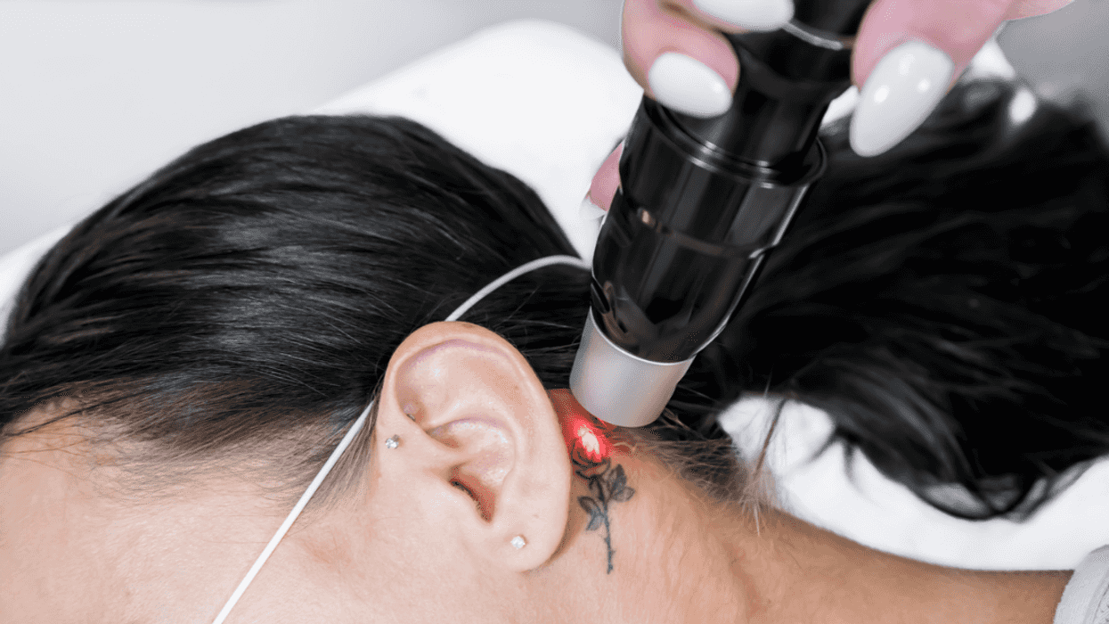 woman getting tattoo removed
