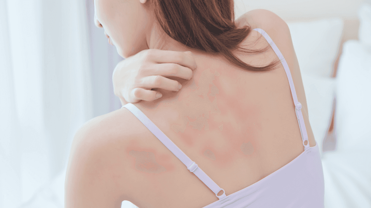 woman with skin irritation