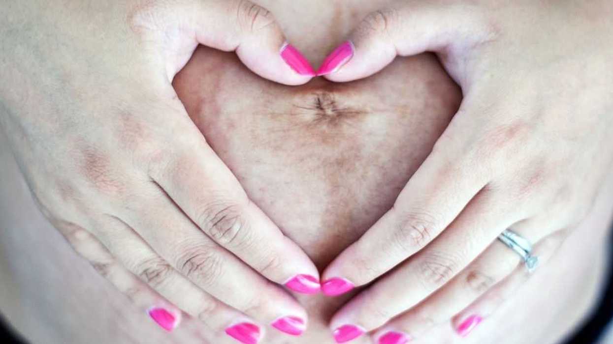 Mom Livid After Friend Advises Her To Wear One-Piece Swimsuit Due To Her Stretch Marks