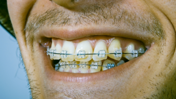 Man smiling with braces