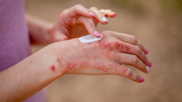 Woman applying cream to hand with skin condition