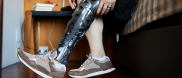 Woman with prosthetic leg