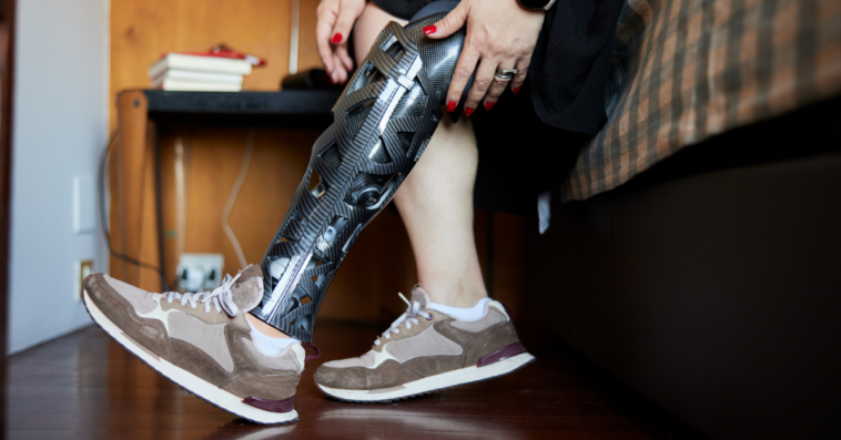 Woman with prosthetic leg