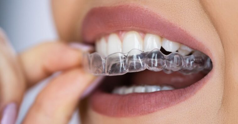 A women puts on a Clear Aligner Dental Night Guard For Teeth