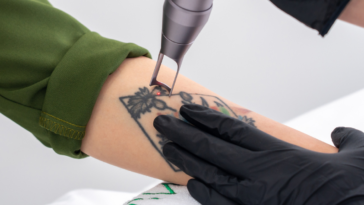 woman having laser tattoo removal done on forearm