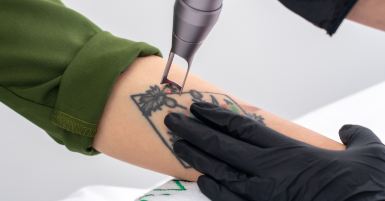 woman having laser tattoo removal done on forearm