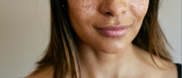 A woman with freckles on her face.