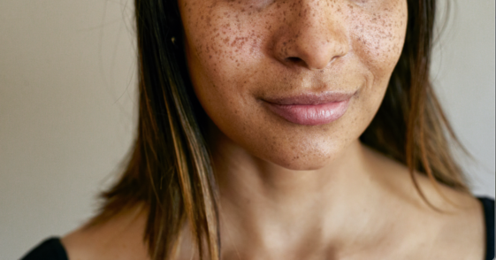 A woman with freckles on her face.