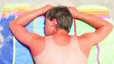 man laying on towel with sunburn