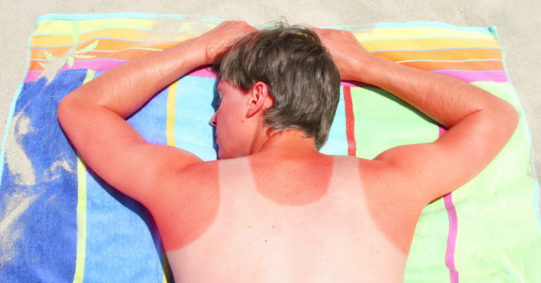 man laying on towel with sunburn