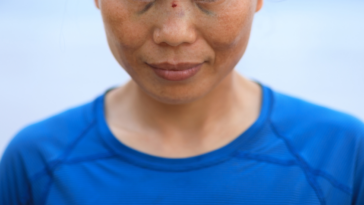 woman with broken nose