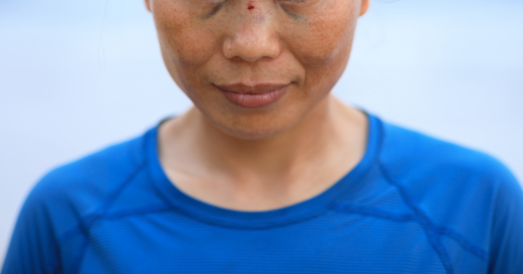 woman with broken nose