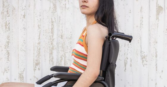 Young handicapped girl with depressed expression looks directly into the camera.